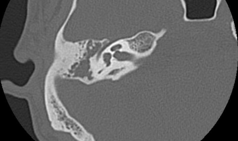 File:Bilateral cholesteatoma (Radiopaedia 54898-61172 Axial bone window 25).jpg