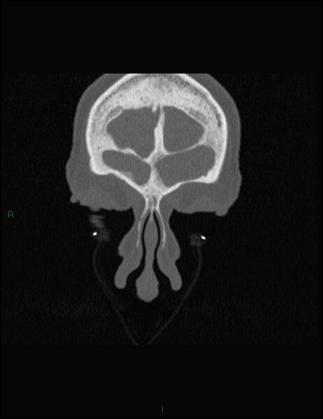 File:Bilateral frontal mucoceles (Radiopaedia 82352-96454 Coronal 53).jpg