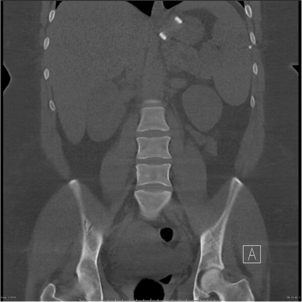 File:Bilateral lumbar ribs (Radiopaedia 25862-26010 Coronal bone window 7).jpg