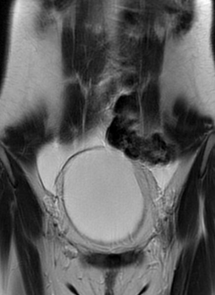 File:Bilateral ovarian fibrothecomas - adolescent (Radiopaedia 86604-102707 Coronal T2 8).jpg