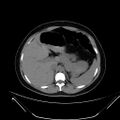 Bilateral ovarian mature cystic teratomas (Radiopaedia 79373-92457 Axial non-contrast 5).jpg