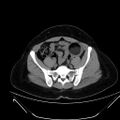 Bilateral ovarian mature cystic teratomas (Radiopaedia 79373-92457 Axial non-contrast 50).jpg