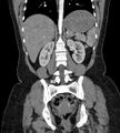 Bilateral ovarian mature cystic teratomas (Radiopaedia 79373-92457 B 59).jpg