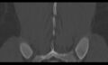 Bilateral pars defect (Radiopaedia 26691-26846 Coronal bone window 42).jpg