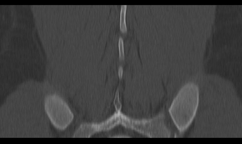 File:Bilateral pars defect (Radiopaedia 26691-26846 Coronal bone window 42).jpg