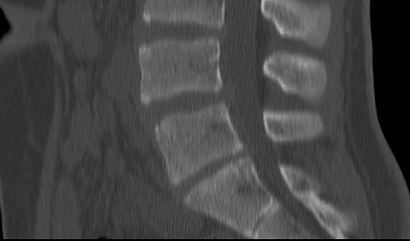 File:Bilateral pars defect (Radiopaedia 26691-26846 Sagittal bone window 31).jpg