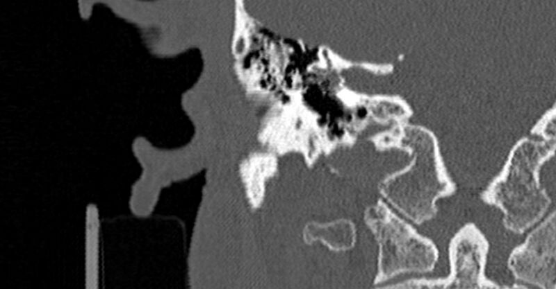 File:Bilateral temporal bone fractures (Radiopaedia 29482-29970 Coronal non-contrast 113).jpg