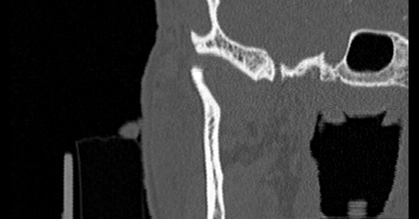 Bilateral temporal bone fractures (Radiopaedia 29482-29970 Coronal non-contrast 27).jpg