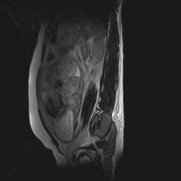 File:Bilobed placenta accreta (Radiopaedia 69648-79591 G 18).jpg