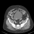 Bladder papillary urothelial carcinoma (Radiopaedia 48119-52951 Axial 45).png