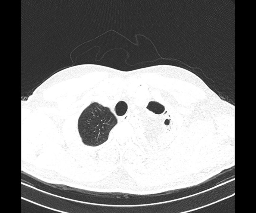Bochdalek hernia - adult presentation (Radiopaedia 74897-85925 Axial lung window 5).jpg