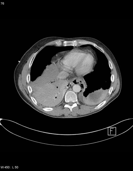 File:Boerhaave syndrome with tension pneumothorax (Radiopaedia 56794-63605 A 37).jpg