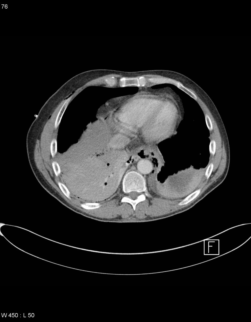 Boerhaave syndrome with tension pneumothorax (Radiopaedia 56794-63605 A 37).jpg