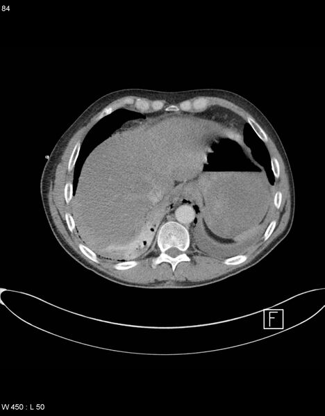 File:Boerhaave syndrome with tension pneumothorax (Radiopaedia 56794-63605 A 41).jpg