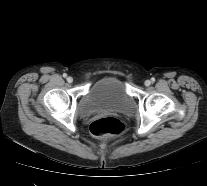 File:Bosniak renal cyst - type IV (Radiopaedia 22929-22953 C 66).jpg