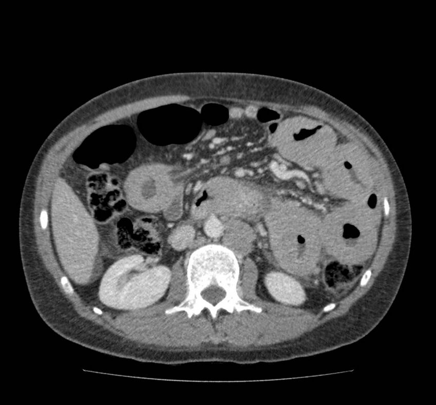 Bowel lymphoma complicated by bleeding after therapy (Radiopaedia 55601-62107 A 37).jpg