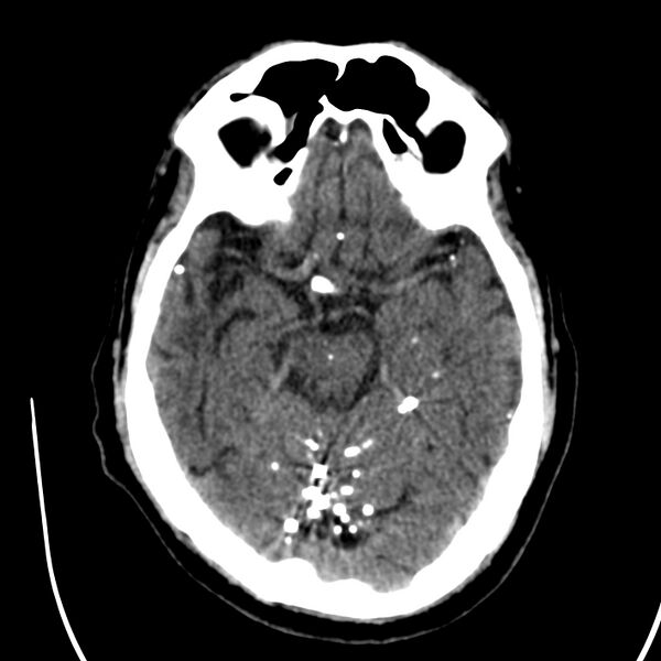 File:Brain Pantopaque remnants (Radiopaedia 78403-91048 Axial non-contrast 40).jpg