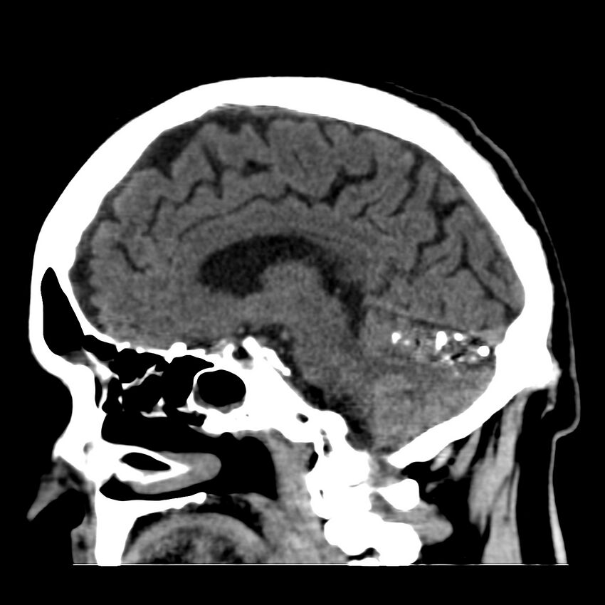 Brain Pantopaque remnants (Radiopaedia 78403-91048 C 26).jpg
