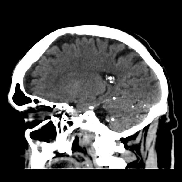 File:Brain Pantopaque remnants (Radiopaedia 78403-91048 C 36).jpg