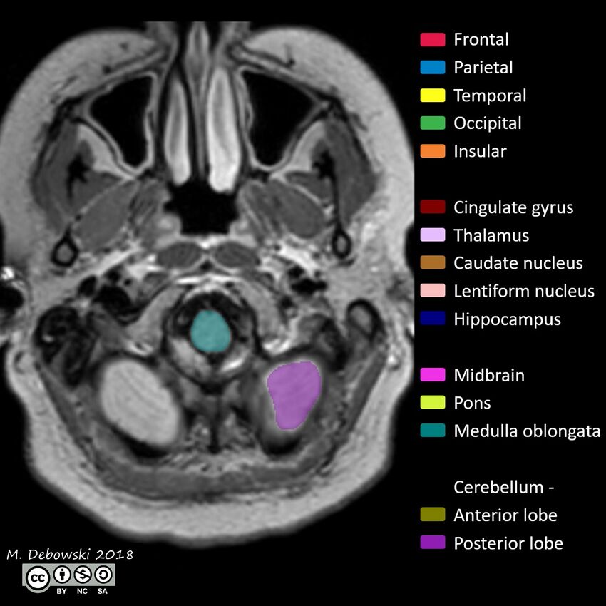 Brain lobes - annotated MRI (Radiopaedia 61691-69700 Axial 74).JPG