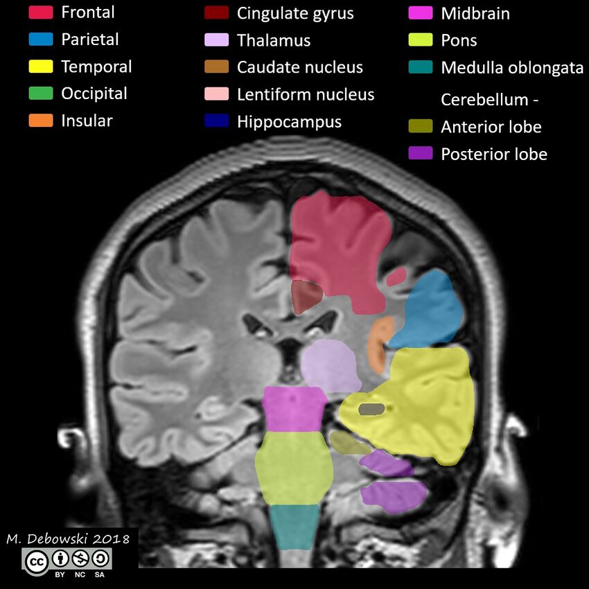 Brain lobes - annotated MRI (Radiopaedia 61691-69700 Coronal 42).JPG
