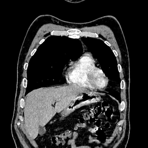 File:Brain metastases - lung cancer primary (Radiopaedia 75060-86116 C+ arterial phase 11).jpg