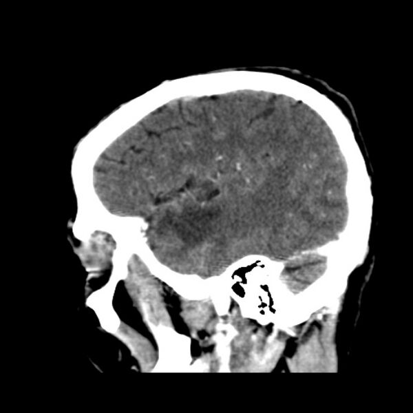 File:Brain metastases from lung cancer (Radiopaedia 24480-24781 C+ delayed 46).jpg