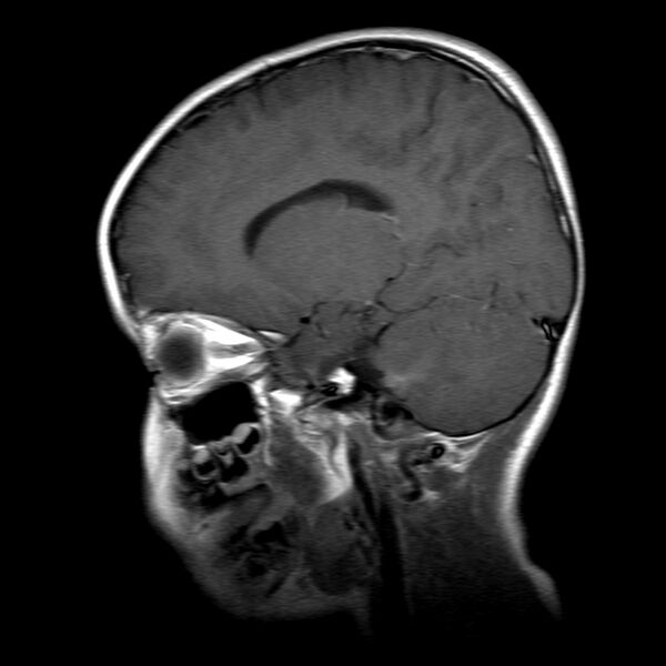 File:Brainstem ganglioglioma (Radiopaedia 10763-11224 Sagittal T1 C+ 12).jpg