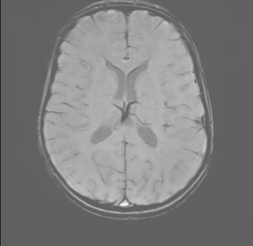 Brainstem glioma (Radiopaedia 70548-80674 Axial SWI 37).jpg