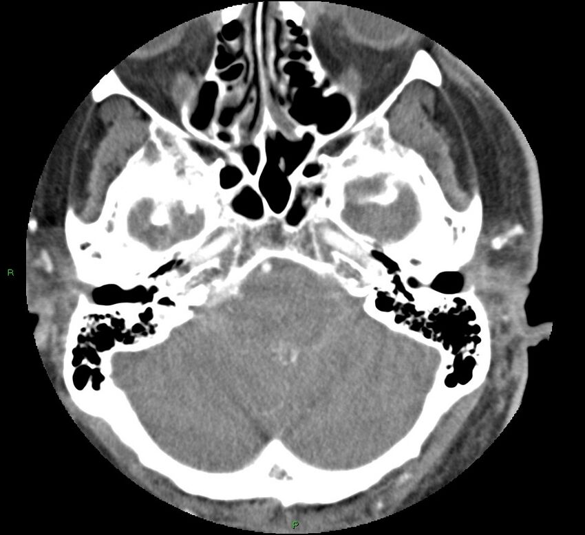 Brainstem hemorrhage (Radiopaedia 58794-66028 D 41).jpg