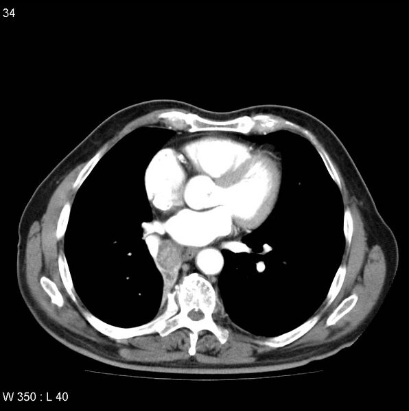 File:Bronchial carcinoid tumor with right lower lobe collapse (Radiopaedia 29060-29422 A 33).jpg