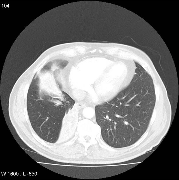 File:Bronchial carcinoid tumor with right lower lobe collapse (Radiopaedia 29060-29422 B 42).jpg