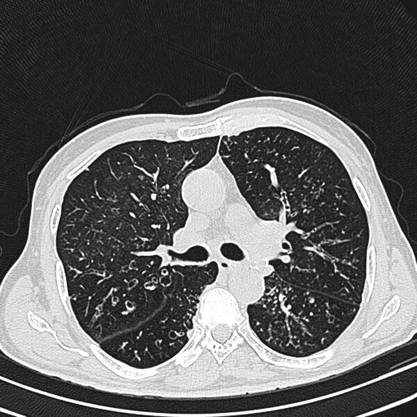 File:Bronchiectasis (Radiopaedia 22061-22059 lung window 13).jpg