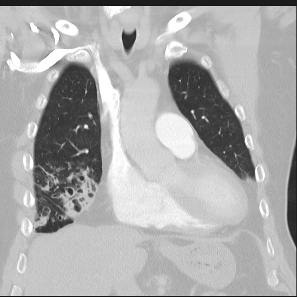 File:Bronchiectasis (Radiopaedia 39385-41666 Coronal lung window 10).png