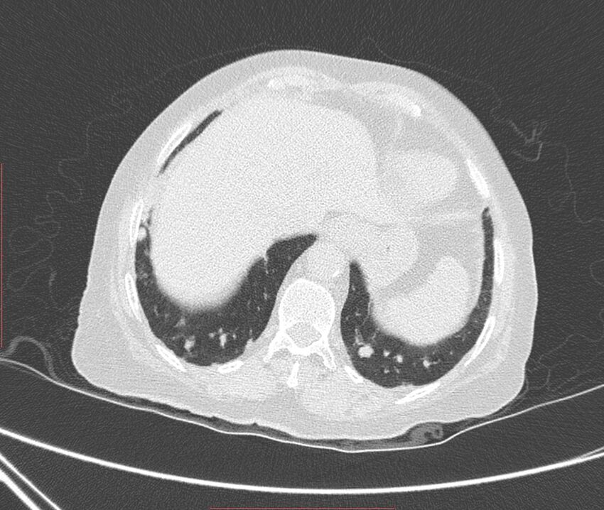 Bronchiectasis (Radiopaedia 72693-83293 Axial lung window 118).jpg