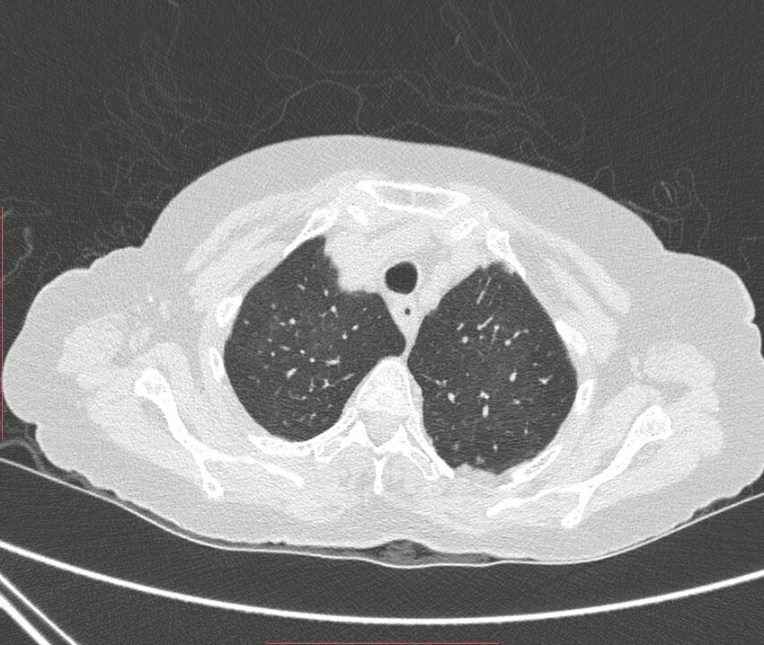 Bronchiectasis (Radiopaedia 72693-83293 Axial lung window 17).jpg