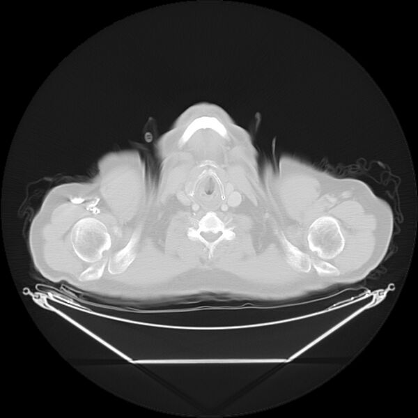 File:Bronchogenic carcinoma with upper lobe collapse (Radiopaedia 29297-29726 Axial lung window 1).jpg