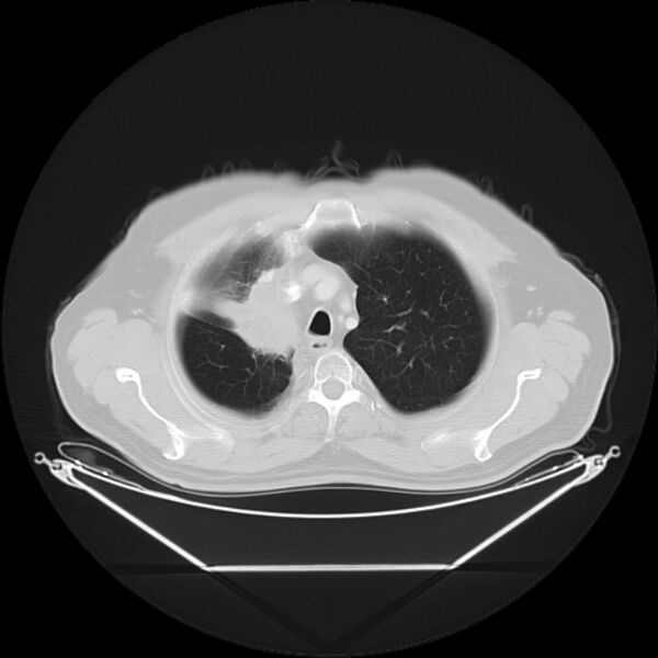 File:Bronchogenic carcinoma with upper lobe collapse (Radiopaedia 29297-29726 Axial lung window 9).jpg