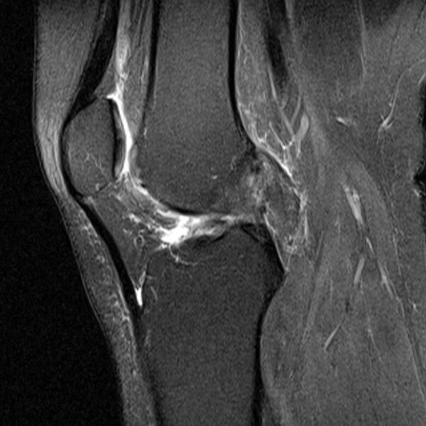 File:Bucket handle tear - medial meniscus (Radiopaedia 79028-91942 Sagittal PD fat sat 11).jpg