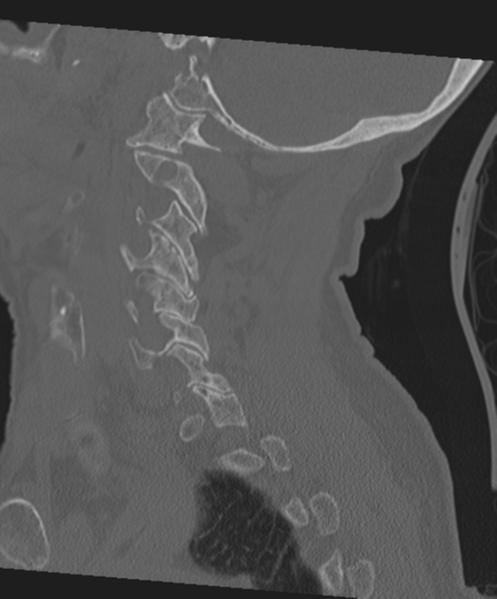 File:C2 fracture with vertebral artery dissection (Radiopaedia 37378-39199 Sagittal bone window 26).png