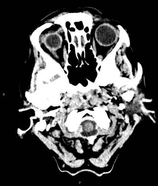 File:Calcified cerebral emboli from left ventricular thrombus (Radiopaedia 84420-99758 Axial non-contrast 83).jpg