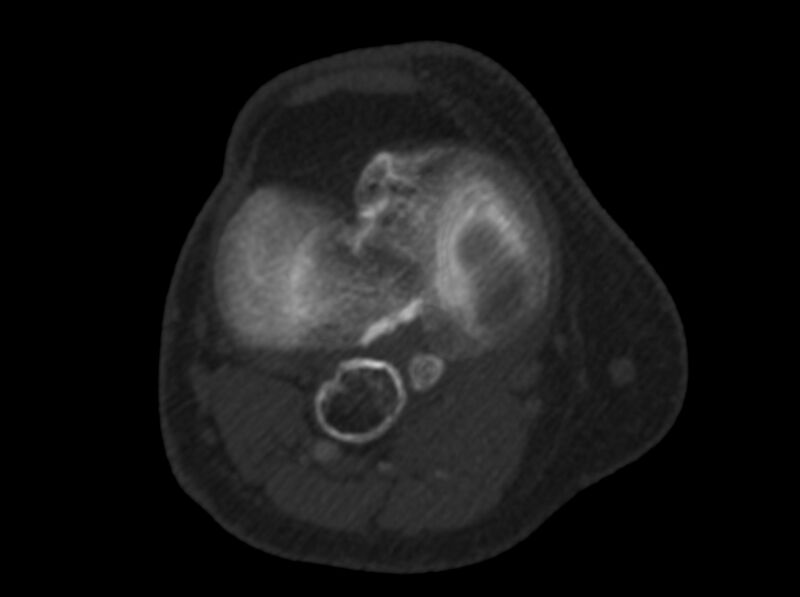 File:Calcified hematoma - popliteal fossa (Radiopaedia 63938-72763 C 30).jpg