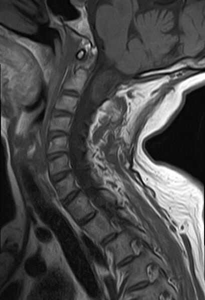 File:Calcified meningioma - cervical canal (Radiopaedia 70136-82468 Sagittal T1 6).jpg