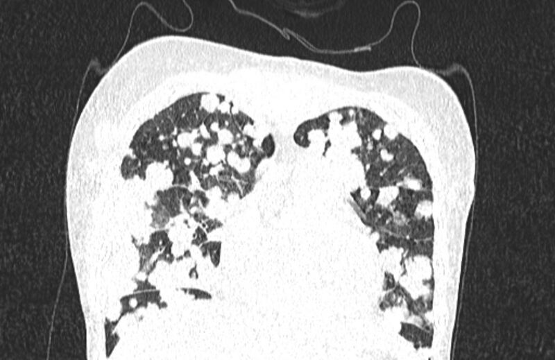 File:Cannonball metastases from breast cancer (Radiopaedia 91024-108569 Coronal lung window 39).jpg
