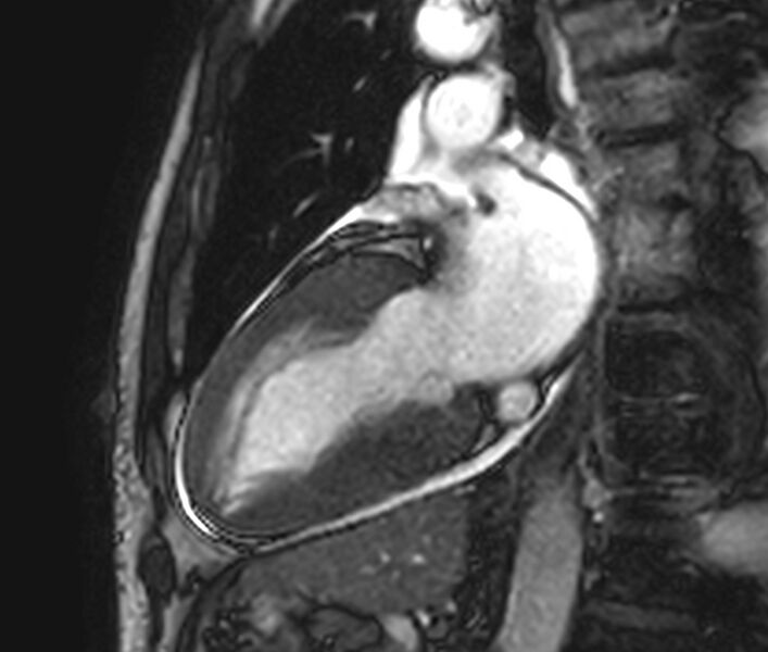 File:Cardiac amyloidosis (Radiopaedia 39736-42124 B 26).jpg