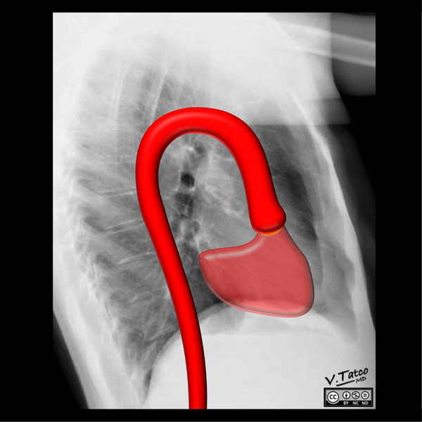 File:Cardiomediastinal anatomy on chest radiography (annotated images) (Radiopaedia 46331-50748 M 1).png