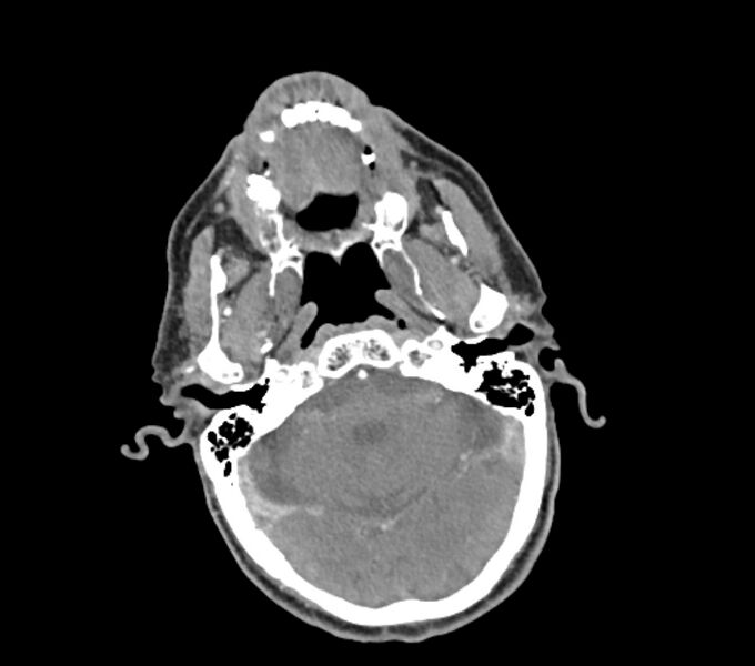 File:Carotid artery pseudoaneurysm (Radiopaedia 84030-99259 C 11).jpg