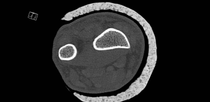 File:Carpal fractures (smart watch impaction) (Radiopaedia 55844-62430 Axial bone window 6).jpg