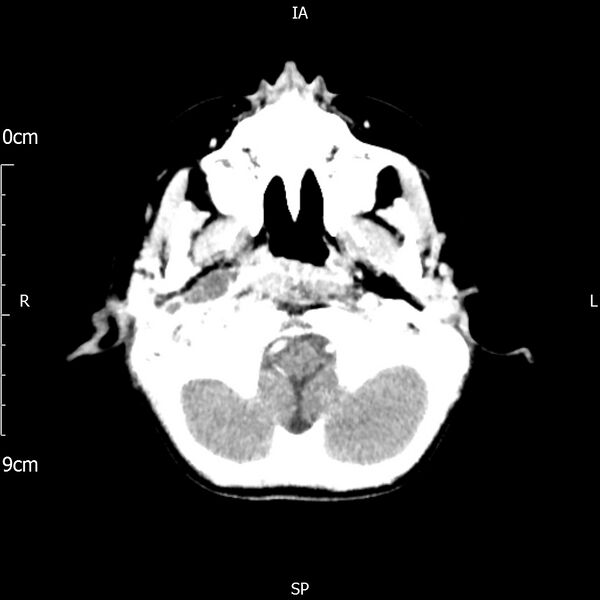 File:Cavernous sinus thrombosis (Radiopaedia 79414-92510 Axial Brain 49).jpg