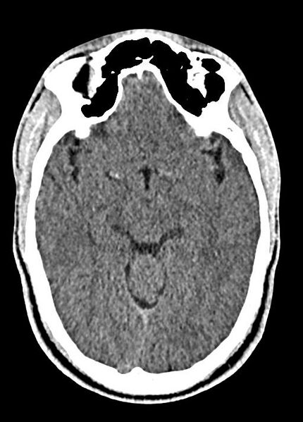 File:Cavum septum pellucidum and cavum vergae (Radiopaedia 77797-90060 Axial Brain Window 44).jpg